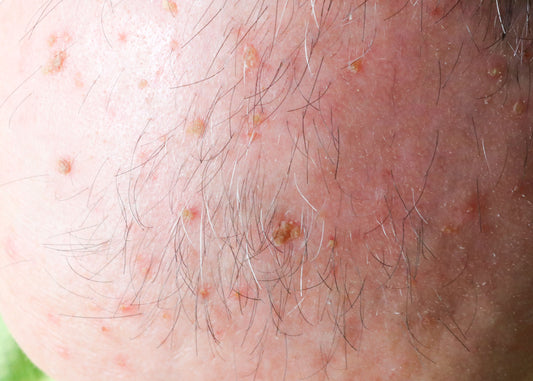 What is Actinic Keratosis?
